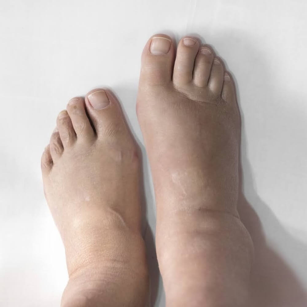 hinchazón de los pies